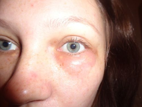 Tikkelés, gyulladás, ödéma: a szemhéj betegségei