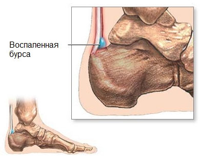 fájdalom a középső ujj középső ízületében sókezelés osteoarthritisben