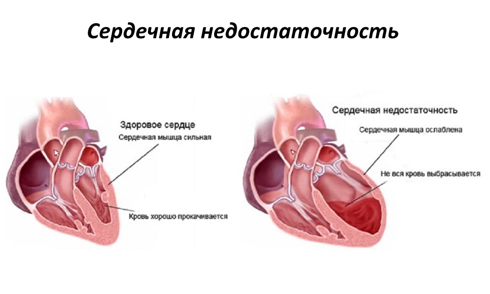 oskultacija srca u hipertenzije)
